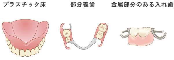 保険の入れ歯